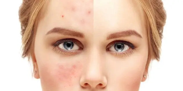 La mejor solución para acabar con el acné de forma efectiva 8 Merca2.es Resultados y hallazgos